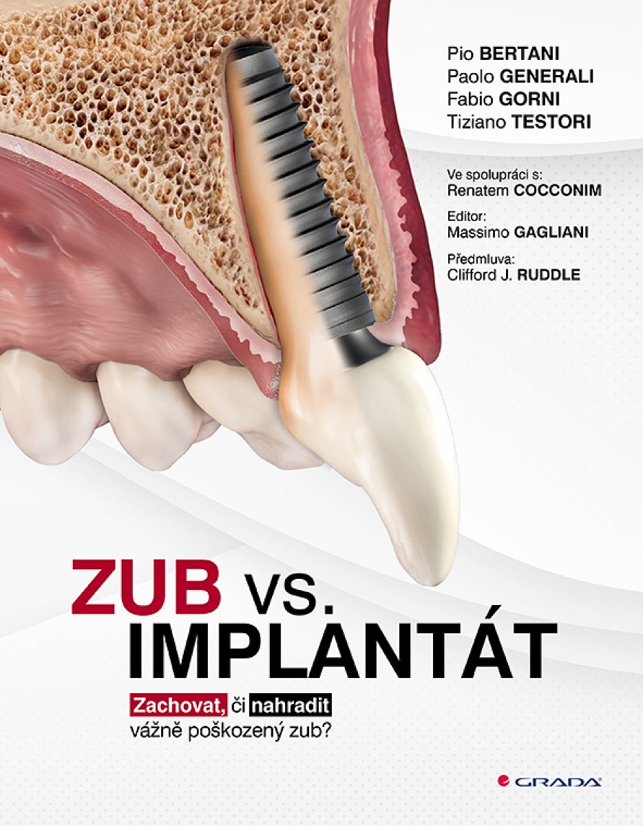 Kniha: Zub vs. implantát od Bertani Pio